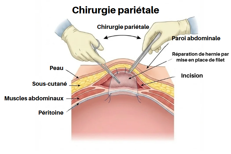 Cure de hernie abdominale avec prothèse par le Dr YASSINE Mohamed à Al Hoceima - Schéma scientifique de chirurgie pariétale Cure de hernie abdominale avec prothèse par le Dr YASSINE Mohamed à Al Hoceima - Schéma scientifique de chirurgie pariétale