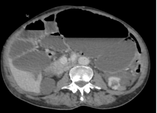 Scanner Volvulus Dr Yassine Tanger
