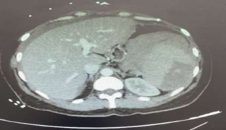 Scanner rupture spontanée de la rate Dr Yassine Tanger