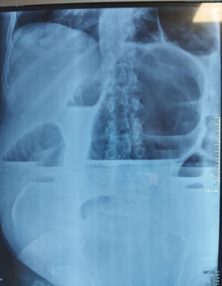 Scanner Volvulus Dr Yassine Tanger