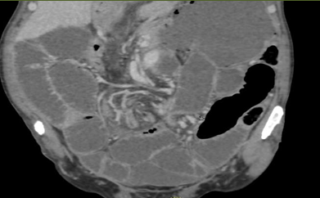 Scanner Volvulus Dr Yassine Tanger