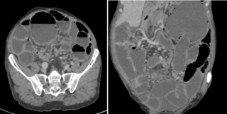 Scanner Volvulus Dr Yassine Tanger