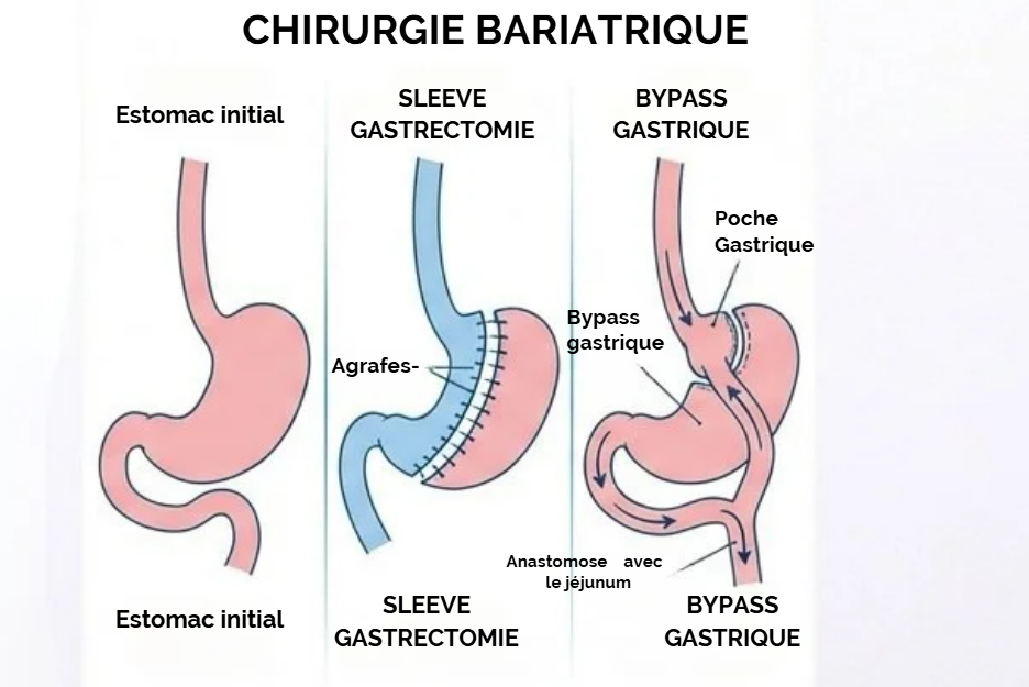 Chirurgie de l'obésité à Al Hoceima par le Dr YASSINE Mohamed - Comparaison scientifique entre Sleeve et Bypass gastrique Chirurgie de l'obésité à Al Hoceima par le Dr YASSINE Mohamed - Comparaison scientifique entre Sleeve et Bypass gastrique