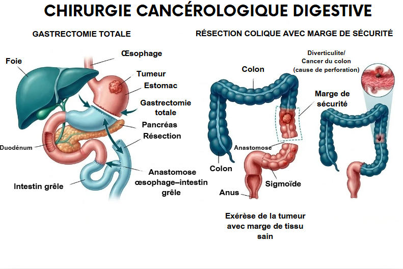 Chirurgie Cancérologique Digestive par le Dr YASSINE Mohamed à Tanger et Al Hoceima - Schéma de gastrectomie et résection colique Chirurgie Cancérologique Digestive par le Dr YASSINE Mohamed à Tanger et Al Hoceima - Schéma de gastrectomie et résection colique