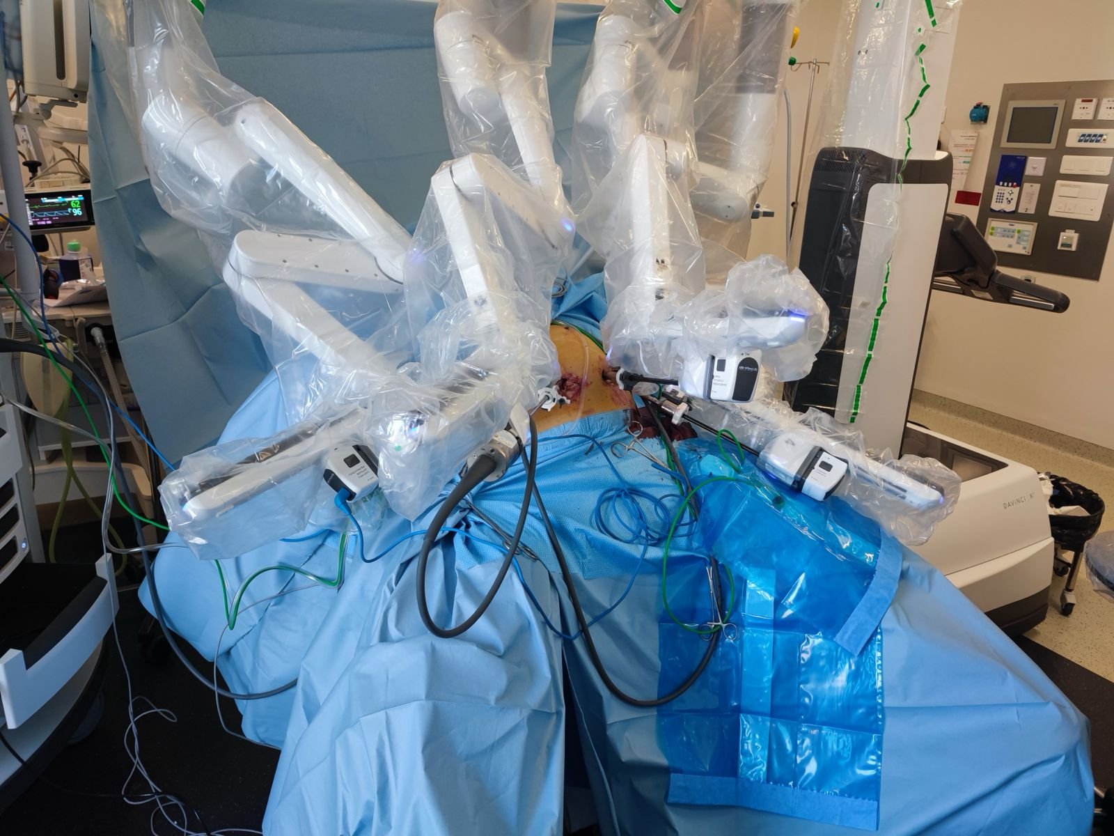 Chirurgie robotique avec le système da Vinci - Dr Yassine Mohamed - Al Hoceima.