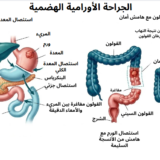 جراحة الأورام الهضمية في الحسيمة مع الدكتور ياسين محمد - رسم توضيحي لاستئصال المعدة الكلي واستئصال القولون مع هامش الأمان