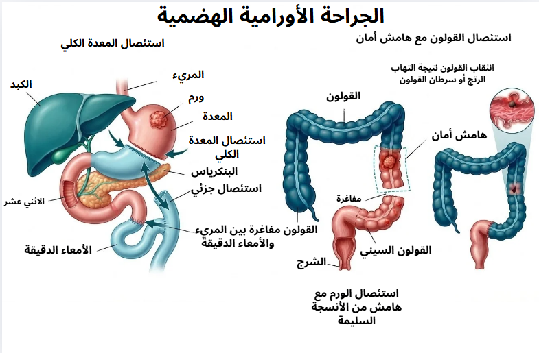 جراحة الأورام الهضمية في الحسيمة مع الدكتور ياسين محمد - رسم توضيحي لاستئصال المعدة الكلي واستئصال القولون مع هامش الأمان