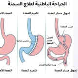 جراحة السمنة في الحسيمة مع الدكتور ياسين محمد - مقارنة علمية بين تكميم المعدة وتحويل مسار المعدة