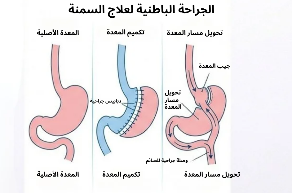 جراحة السمنة في الحسيمة مع الدكتور ياسين محمد - مقارنة علمية بين تكميم المعدة وتحويل مسار المعدة