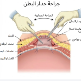 علاج الفتق في الحسيمة مع الدكتور ياسين محمد - رسم توضيحي لجراحة جدار البطن وإصلاح الفتق بواسطة الشبكة الجراحية