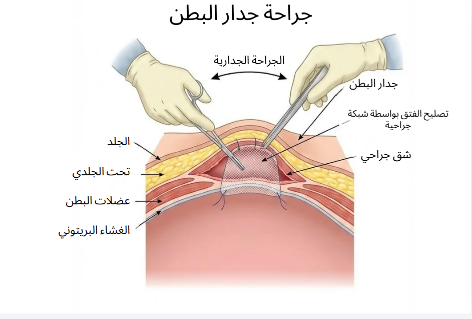 علاج الفتق في الحسيمة مع الدكتور ياسين محمد - رسم توضيحي لجراحة جدار البطن وإصلاح الفتق بواسطة الشبكة الجراحية